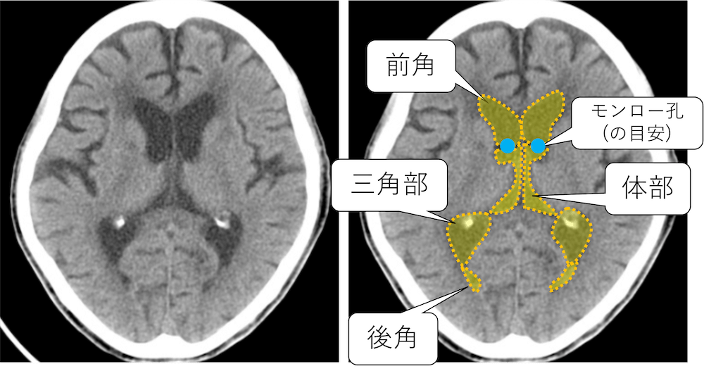 脳MRI 1(正常解剖) - 本